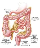大便出血是怎么回事
