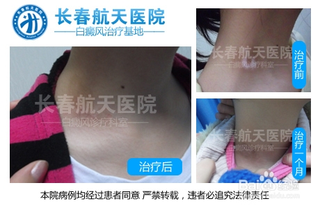 bb患者冬季要做些什么