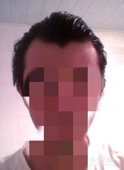 M型 美人尖如何区分