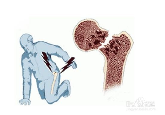 股骨头坏死怎么止痛