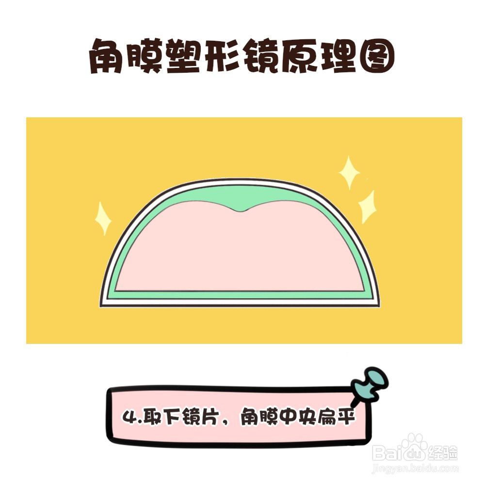 角膜塑形镜的原理