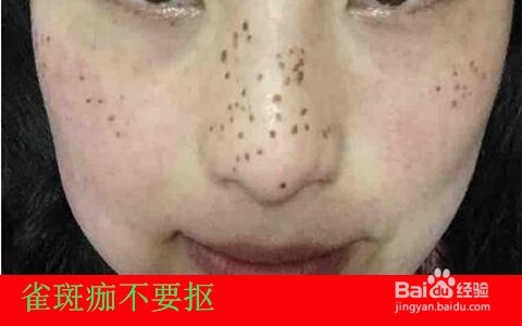 用药水点斑后怎么护理/点斑水点斑后如何保养