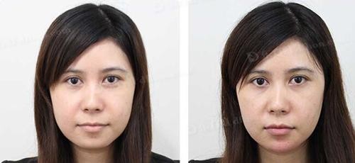 玻尿酸打下巴青了 这篇攻略带你走出困境