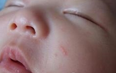 皮肤科医生揭示痤疮的主要原因