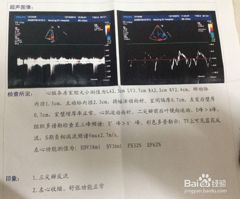 初生婴儿要不要做心脏彩超及注意事项