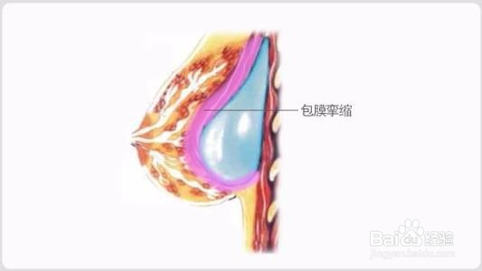 什么是包膜挛缩