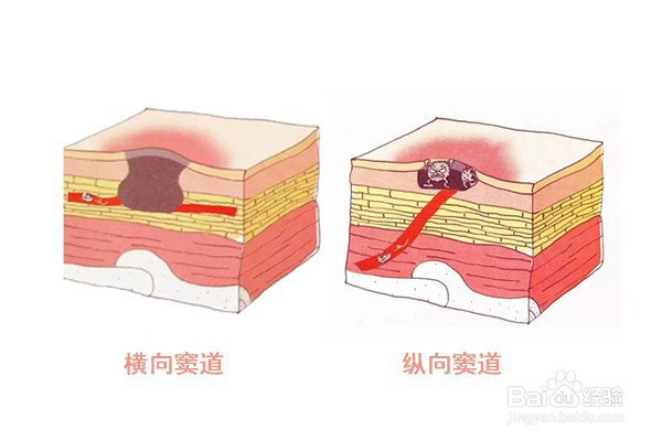窦道型褥疮治疗最佳方法
