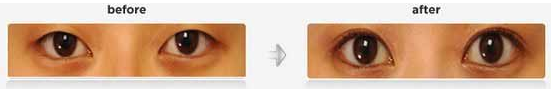 如何才能使双眼皮术后快速恢复