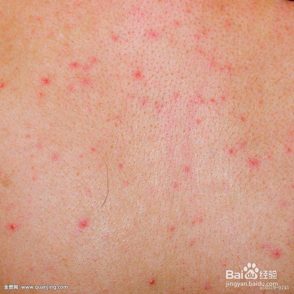 身上起红疙瘩很痒怎么办
