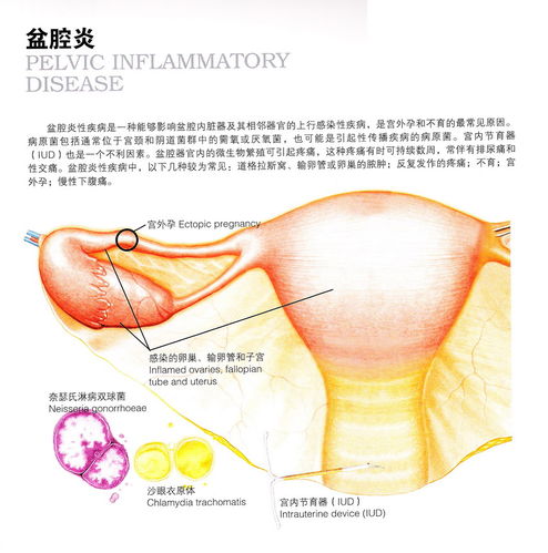 盆腔炎该做的检查