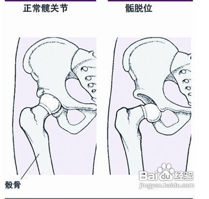 长春股骨头坏死的高危人群
