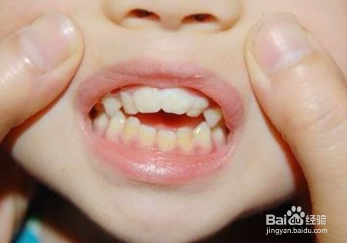 孩子换牙时该注意些什么？