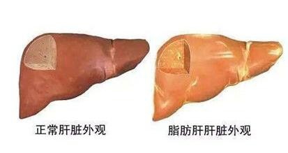 怎样正确认识脂肪肝