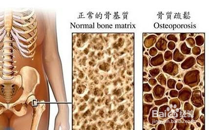 怎么辨别自己是否缺钙