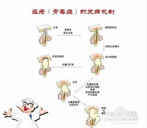 痤疮丙酸杆菌