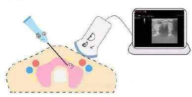 甲状腺结节消融手术注意事项