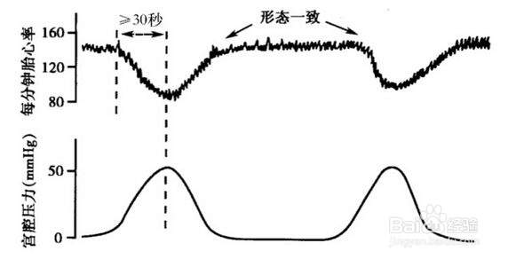 胎心监护加速减速是什么为什么胎心监护曲线平
