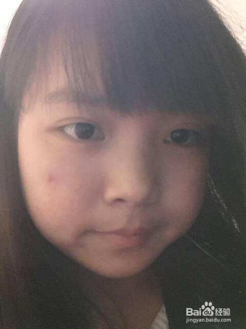 如何有效去除暗疮？