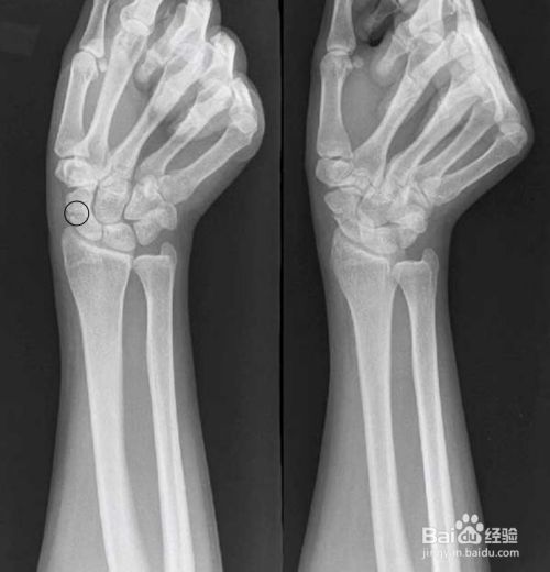 腕部骨折中的隐形杀手 百度经验 腕部骨折中的隐形杀手 百度经验