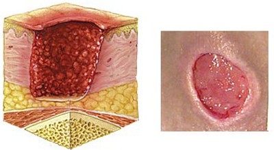 压疮的治疗方法