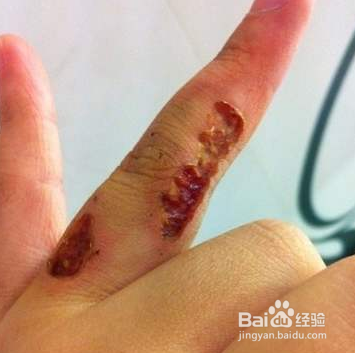 纹身后悔了怎么办