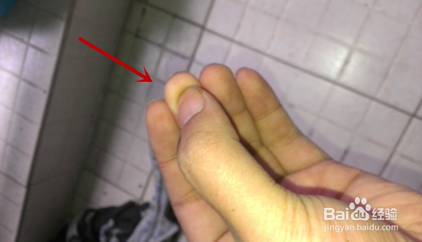 容易流鼻血怎么办流鼻血怎么处理