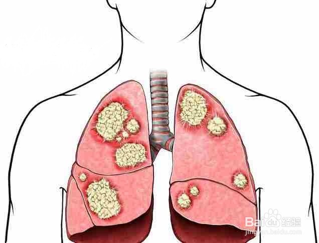 肺纤维化的患病因素你了解了吗？