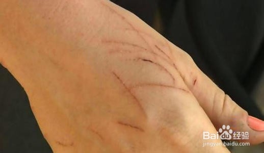 被猫抓伤怎么办