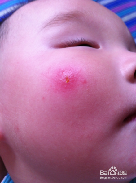 宝宝让蚊子叮了红肿怎么处理