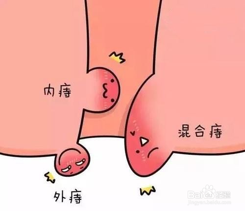 痔疮如何避免开刀