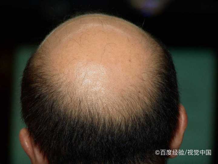 秋季掉头发多怎么办？脱发怎么办？