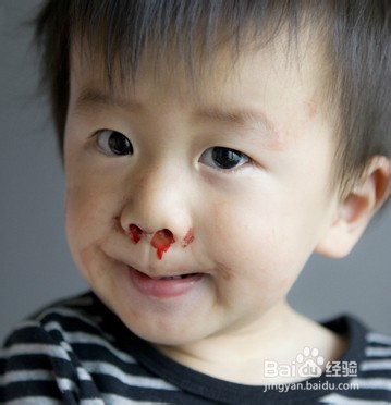 流鼻血了怎么办？