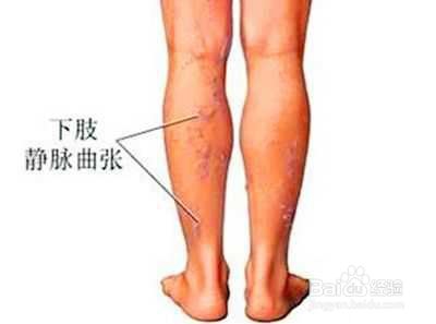 孕妇身体和脚浮肿的原因和消去浮肿的方法