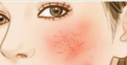 如何去除红血丝