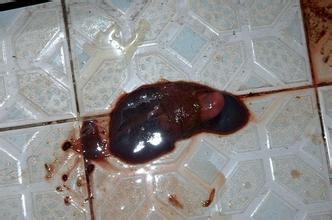各种类型的流产的处理方法