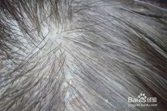 专家经验：毛囊退化后要如何生发的几种方法