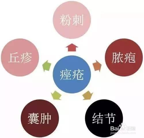 如何预防和治疗脂溢性皮炎