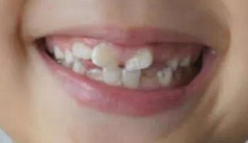 孩子换牙家长必须知道的事情