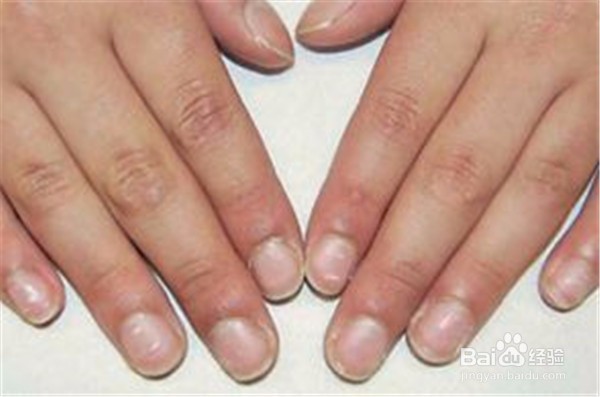 指甲上长白色的斑是怎么一回事?