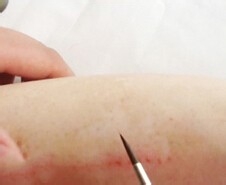 白斑遮盖液怎么使用