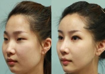 常见的双眼皮手术失败修复方法