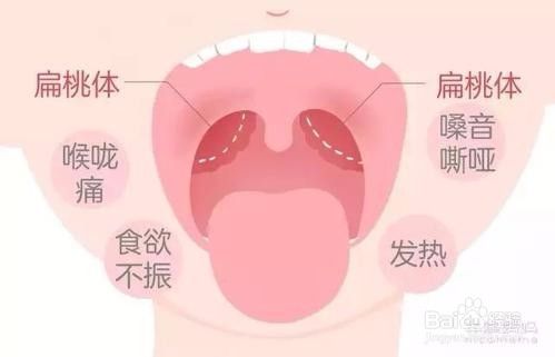 孩子扁桃腺发炎该不该切除 百度经验