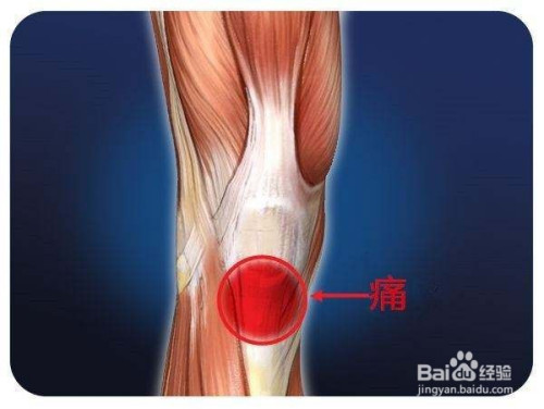 髌骨软化症要怎么办