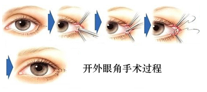 开眼角多长时间恢复