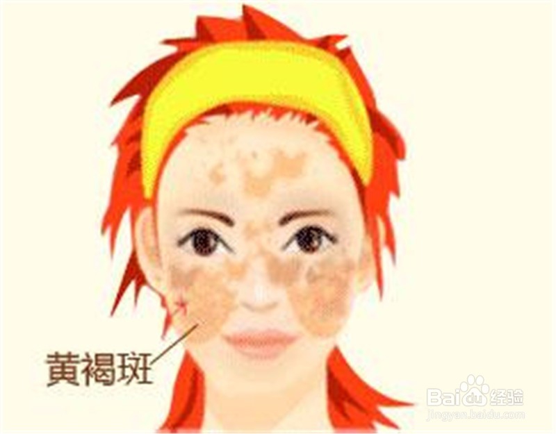 黄褐斑颜色发黄的妹纸祛斑要先补脾