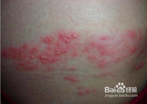 去角质哪些人要慎重