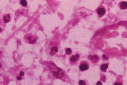 有炎症的时候饮食方面要注意什么