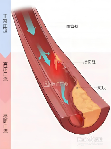 如何预防高血压?