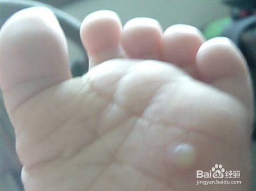 如何预防手足口病