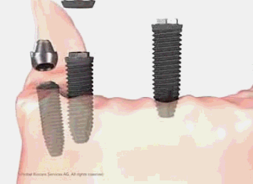 种植牙真的有那么好吗?